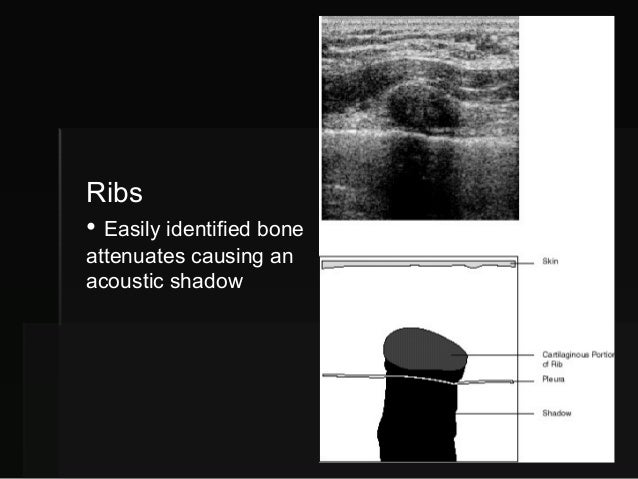 breast ultrasound shadow Zinc crooslinkers for latex
